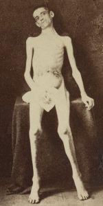 graphic photo of emaciated former prisoner sitting on a covered pedestal